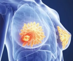 Read more about the article Breast Cancer: Symptoms, Stages, Diagnosis, and Treatment