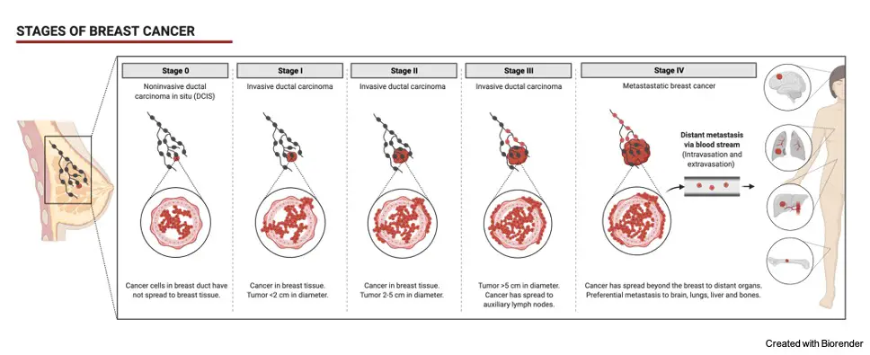 Breast Cancer- Symptoms, Stages, Diagnosis, and Treatment 1