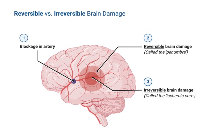 Brain Damage